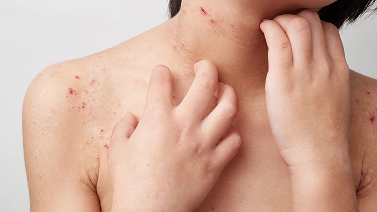 子供におけるアトピー性皮膚炎の原因