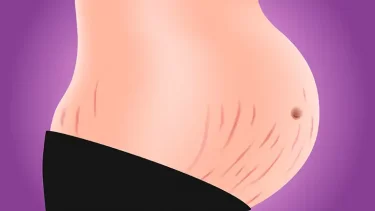 妊娠線ができやすい人とは？妊娠線予防オイルとクリームの違いは？おすすめの産後ケア方法